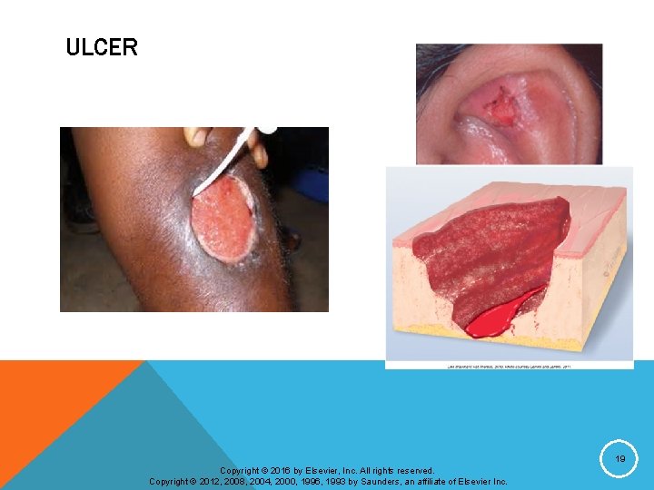 ULCER 19 Copyright © 2016 by Elsevier, Inc. All rights reserved. Copyright © 2012,