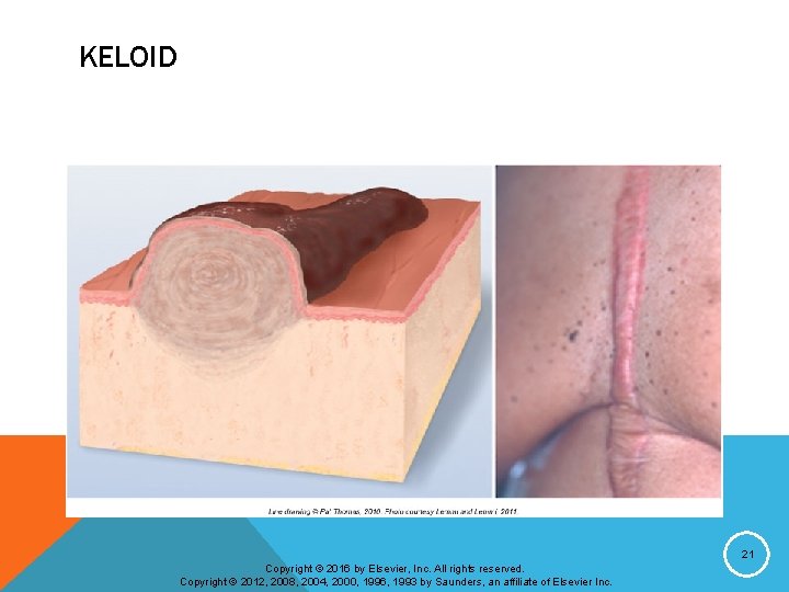 KELOID 21 Copyright © 2016 by Elsevier, Inc. All rights reserved. Copyright © 2012,