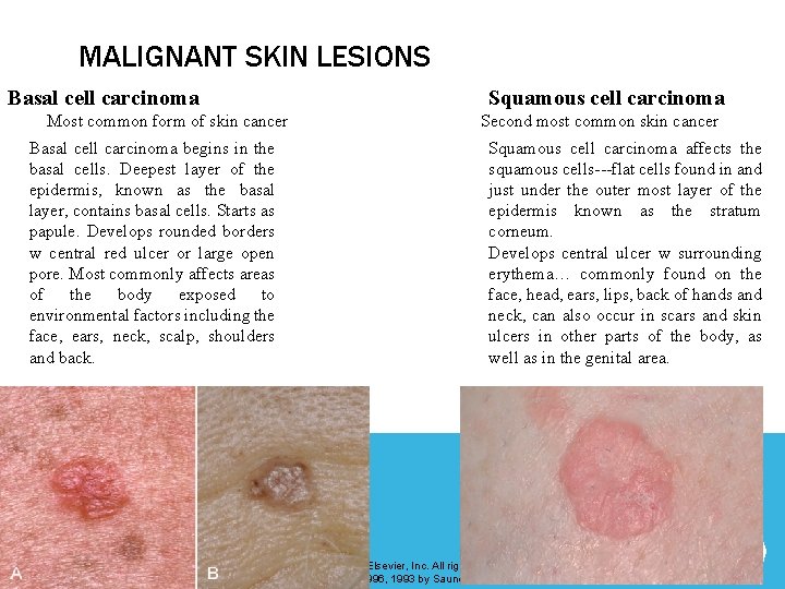 MALIGNANT SKIN LESIONS Basal cell carcinoma Most common form of skin cancer Basal cell