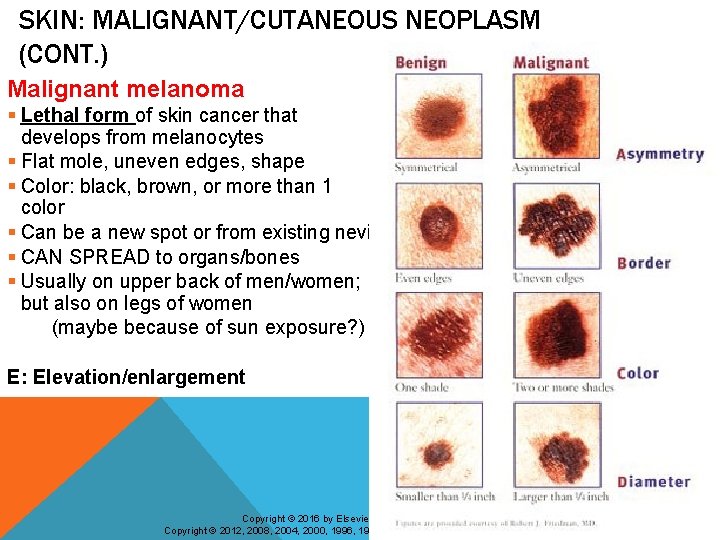 SKIN: MALIGNANT/CUTANEOUS NEOPLASM (CONT. ) Malignant melanoma § Lethal form of skin cancer that