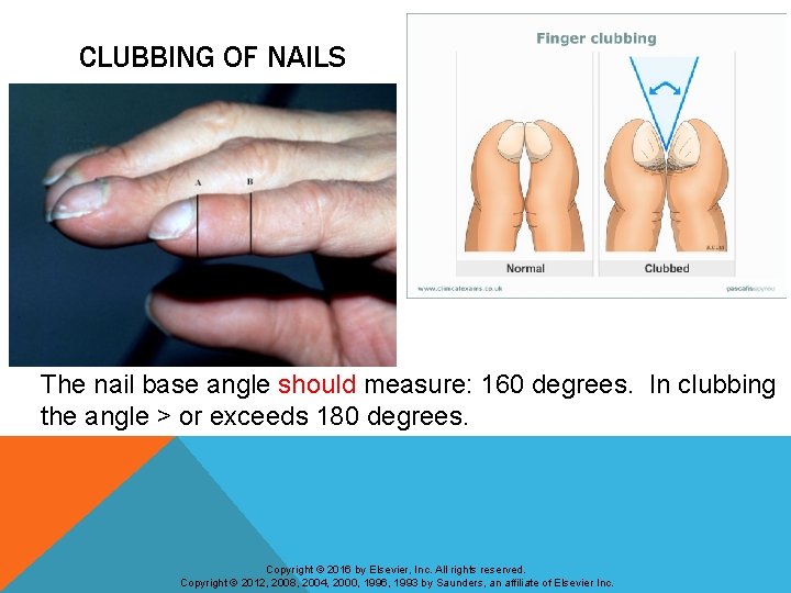 CLUBBING OF NAILS The nail base angle should measure: 160 degrees. In clubbing the