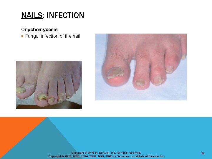 NAILS: INFECTION Onychomycosis § Fungal infection of the nail Copyright © 2016 by Elsevier,