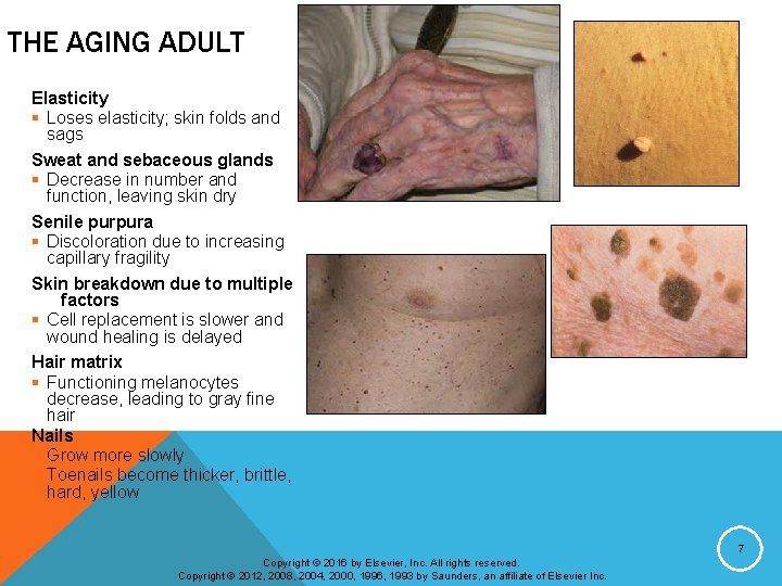 THE AGING ADULT Elasticity § Loses elasticity; skin folds and sags Sweat and sebaceous