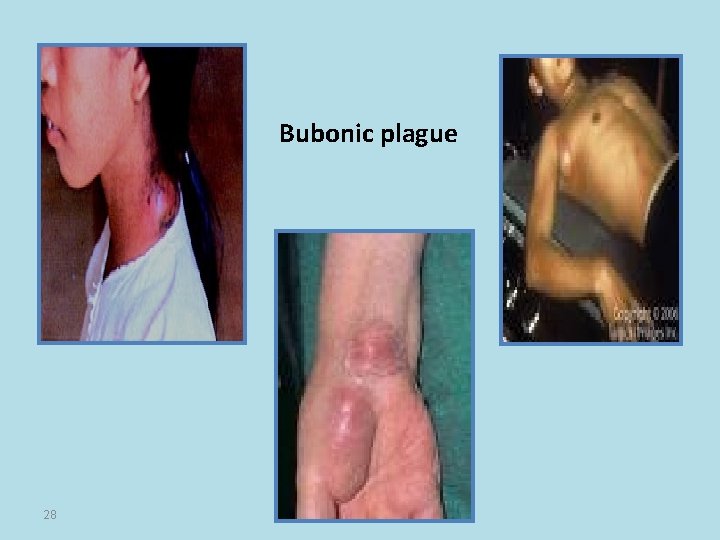 Bubonic plague 28 