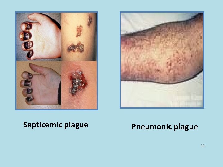 Septicemic plague Pneumonic plague 30 