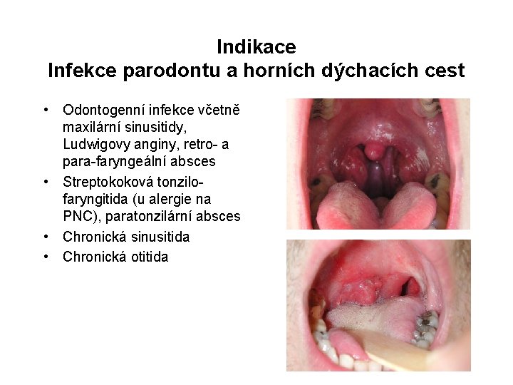 Indikace Infekce parodontu a horních dýchacích cest • Odontogenní infekce včetně maxilární sinusitidy, Ludwigovy