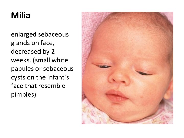 Milia enlarged sebaceous glands on face, decreased by 2 weeks. (small white papules or