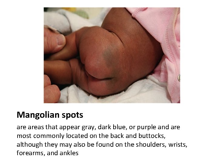 Mangolian spots areas that appear gray, dark blue, or purple and are most commonly