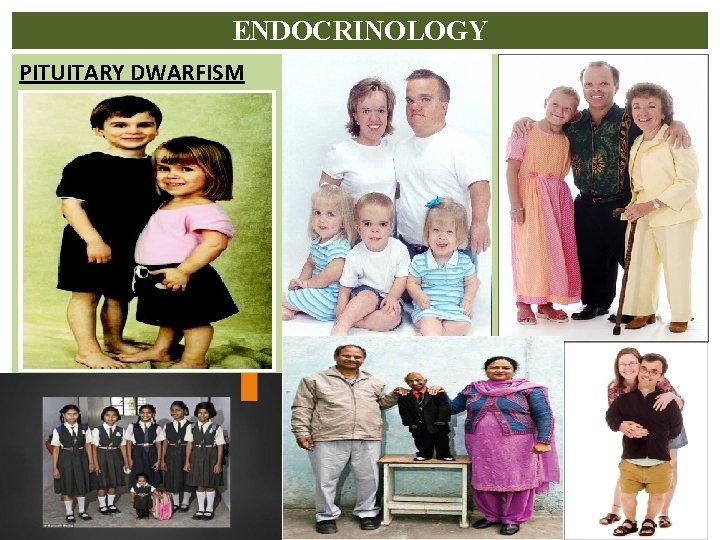 ENDOCRINOLOGY PITUITARY DWARFISM 