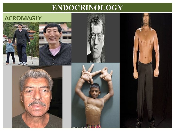 ENDOCRINOLOGY ACROMAGLY 