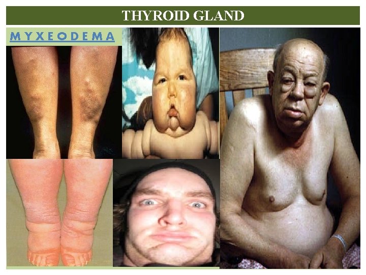 THYROID GLAND MYXEODEMA 
