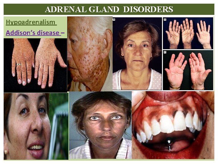 ADRENAL GLAND DISORDERS Hypoadrenalism Addison’s disease – 