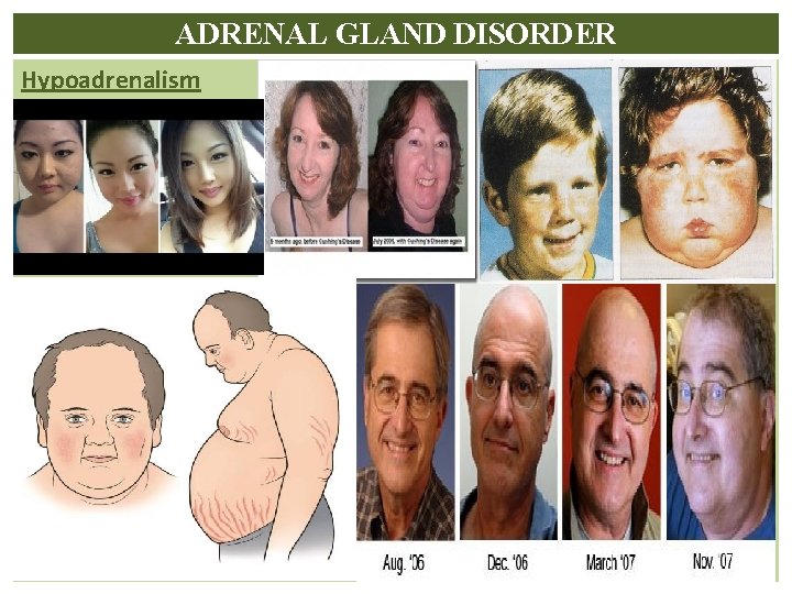 ADRENAL GLAND DISORDER Hypoadrenalism Cushing’s syndrome – 