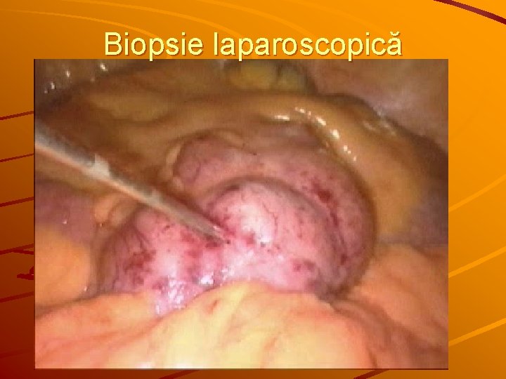 Biopsie laparoscopică 