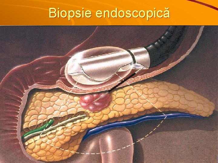 Biopsie endoscopică 