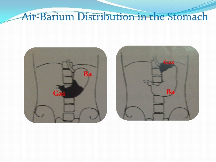 Air-Barium Distribution in the Stomach Gas Ba 