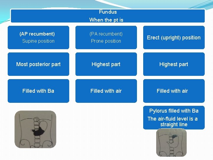 Fundus When the pt is (AP recumbent) Supine position (PA recumbent) Prone position Erect