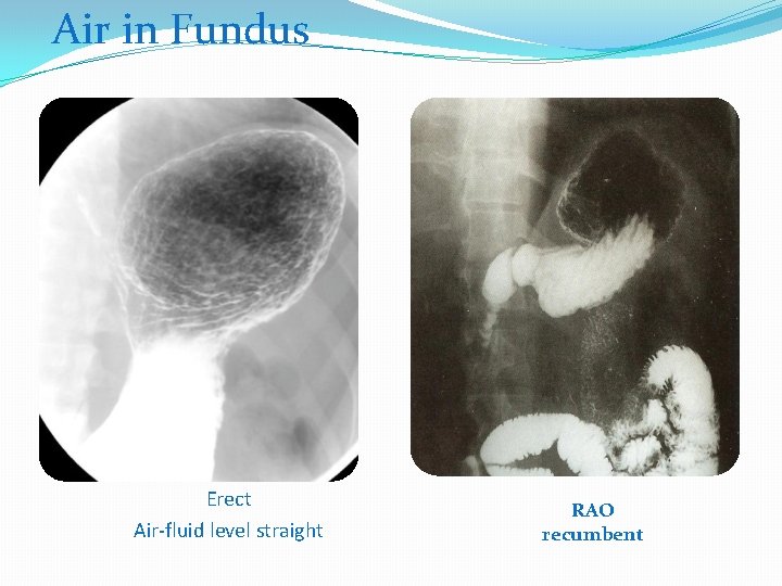 Air in Fundus Erect Air-fluid level straight RAO recumbent 