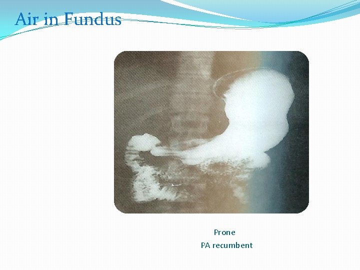 Air in Fundus Prone PA recumbent 