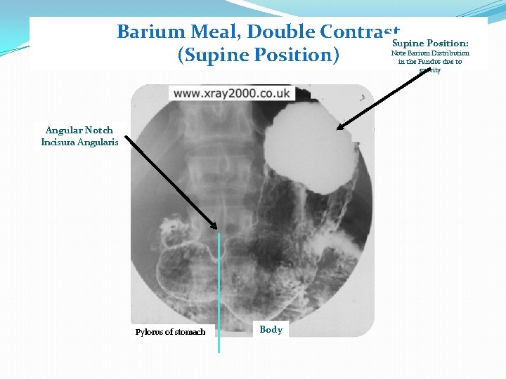 Barium Meal, Double Contrast. Supine Position: (Supine Position) Note Barium Distribution in the Fundus