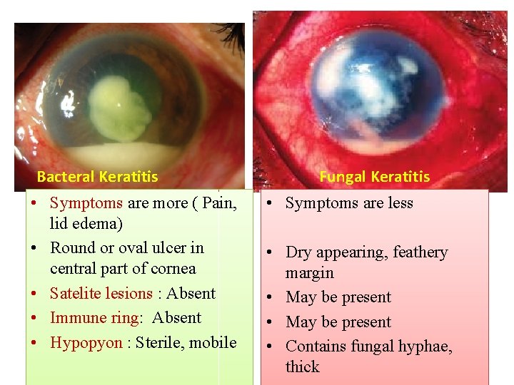 Bacteral Keratitis • Symptoms are more ( Pain, lid edema) • Round or oval