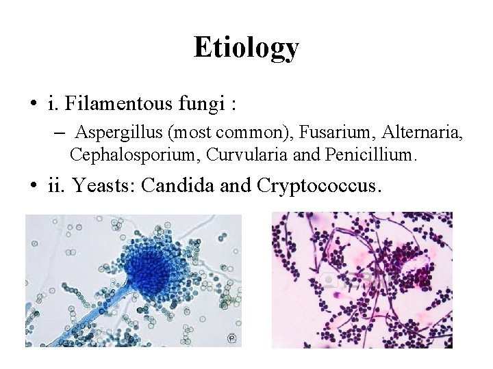Etiology • i. Filamentous fungi : – Aspergillus (most common), Fusarium, Alternaria, Cephalosporium, Curvularia