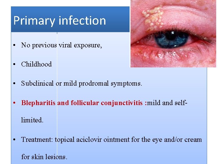 Primary infection • No previous viral exposure, • Childhood • Subclinical or mild prodromal