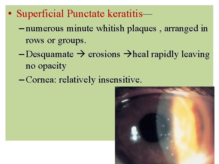  • Superficial Punctate keratitis— – numerous minute whitish plaques , arranged in rows