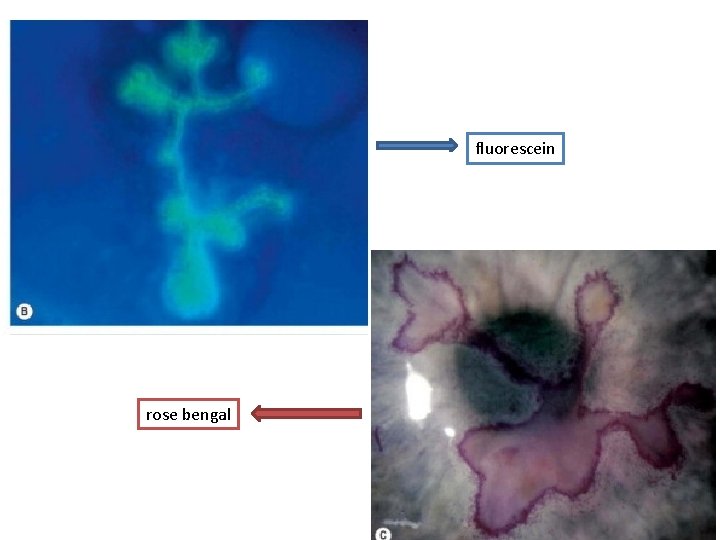 fluorescein rose bengal 