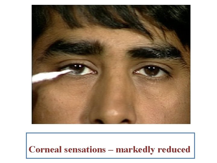 Corneal sensations – markedly reduced 