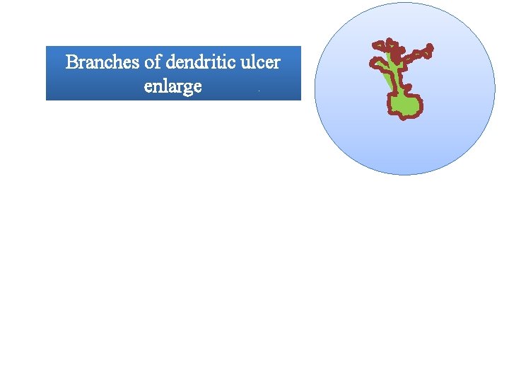 Branches of dendritic ulcer enlarge Steroid use Coalesce to form a large epithelial ulcer