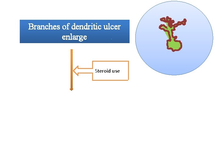 Branches of dendritic ulcer enlarge Steroid use Coalesce to form a large epithelial ulcer