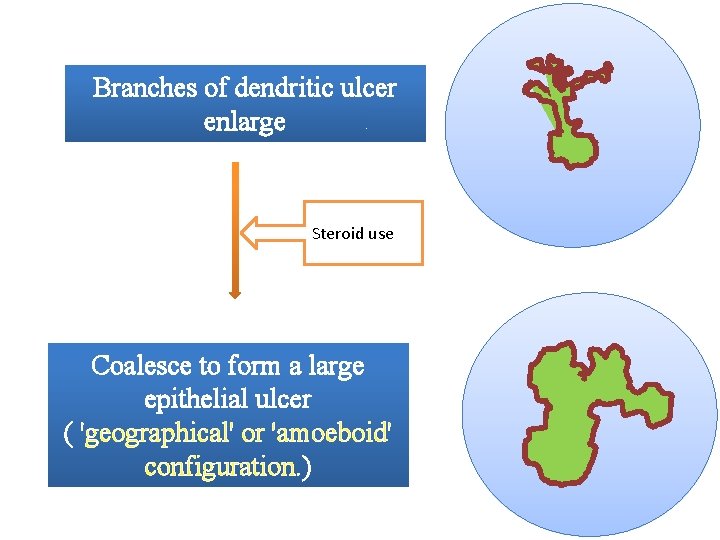 Branches of dendritic ulcer enlarge Steroid use Coalesce to form a large epithelial ulcer