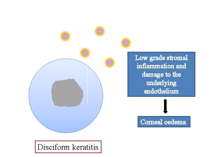 Low grade stromal inflammation and damage to the underlying endothelium Corneal oedema Disciform keratitis