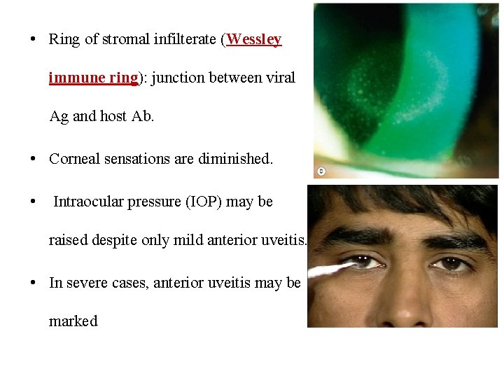  • Ring of stromal infilterate (Wessley immune ring): junction between viral Ag and