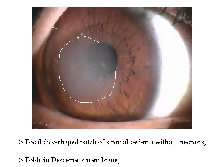 > Focal disc-shaped patch of stromal oedema without necrosis, > Folds in Descemet's membrane,