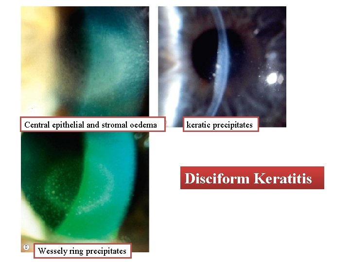 Central epithelial and stromal oedema keratic precipitates Disciform Keratitis Wessely ring precipitates 
