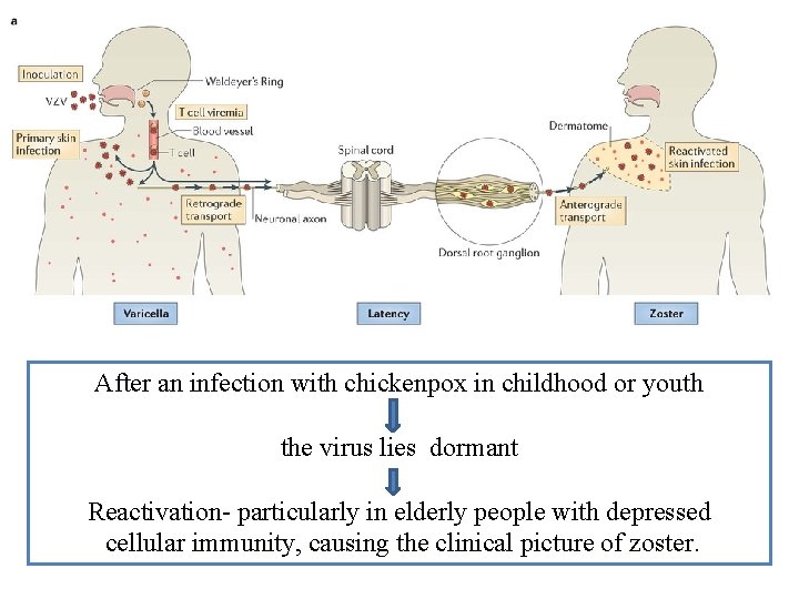 After an infection with chickenpox in childhood or youth the virus lies dormant Reactivation-
