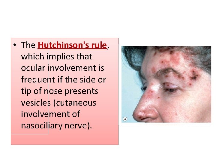  • The Hutchinson's rule, which implies that ocular involvement is frequent if the