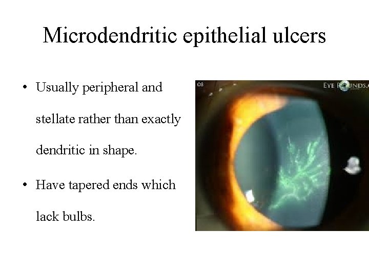Microdendritic epithelial ulcers • Usually peripheral and stellate rather than exactly dendritic in shape.