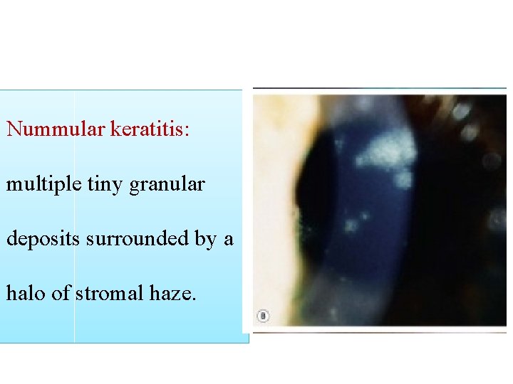 Nummular keratitis: multiple tiny granular deposits surrounded by a halo of stromal haze. 