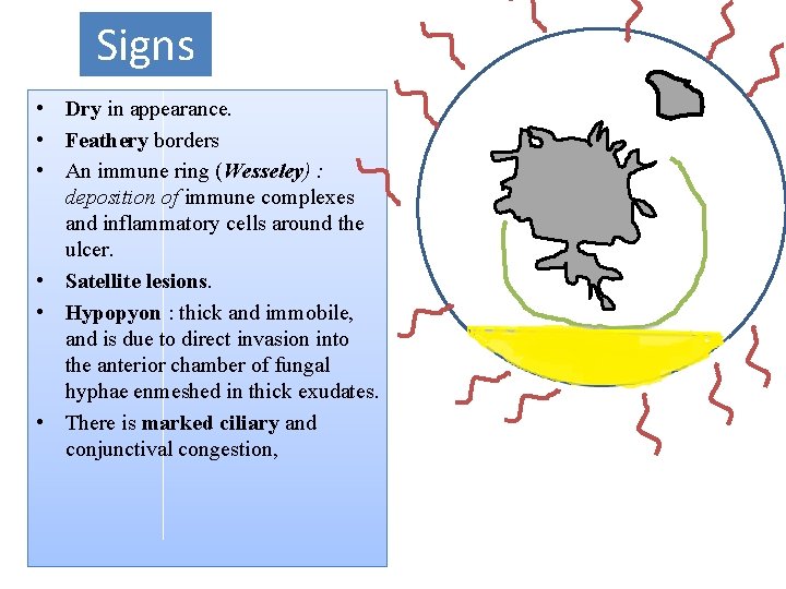 Signs • Dry in appearance. • Feathery borders • An immune ring (Wesseley) :