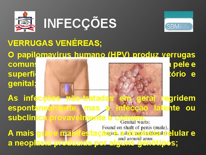 INFECÇÕES VERRUGAS VENÉREAS; O papilomavírus humano (HPV) produz verrugas comuns e verrugas plantares no