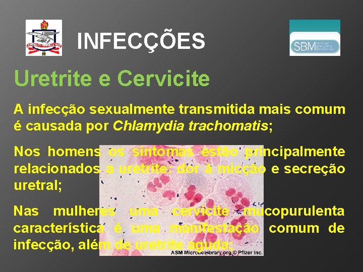 INFECÇÕES Uretrite e Cervicite A infecção sexualmente transmitida mais comum é causada por Chlamydia