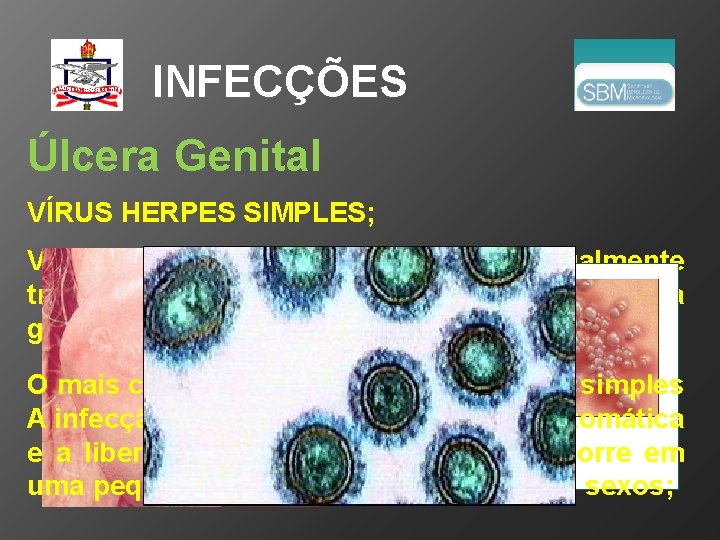 INFECÇÕES Úlcera Genital VÍRUS HERPES SIMPLES; Vários agentes infecciosos, muitos sexualmente transmitidos, produzem lesões