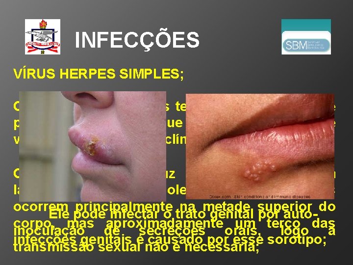 INFECÇÕES VÍRUS HERPES SIMPLES; O vírus herpes simples tem dois sorotipos, que produzem infecções