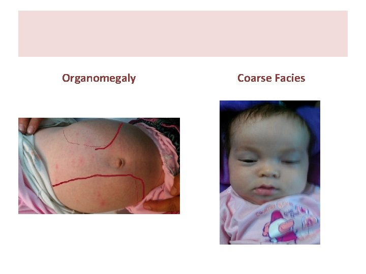 Organomegaly Coarse Facies Organomegaly Coarse Facies