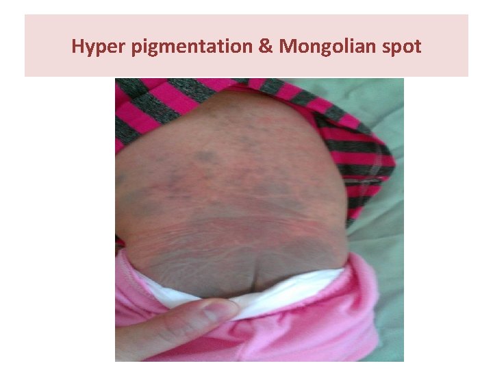 Hyper pigmentation & Mongolian spot 