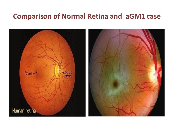 Comparison of Normal Retina and a. GM 1 case 