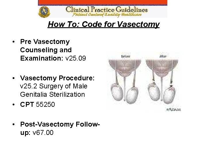 How To: Code for Vasectomy • Pre Vasectomy Counseling and Examination: v 25. 09